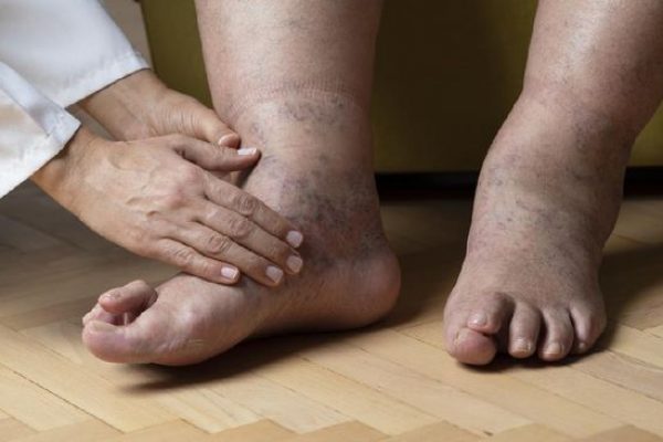 Is Leg Edema Dangerous?