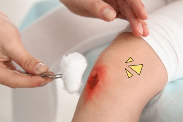 Cara Penanganan Luka dan 3 Macam Obat Luka