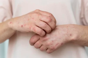 apa itu monkeypox, monkeypox, ruam di tangan, bintik-bintik di tangan