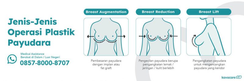 operasi plastik payudara, breast lifting, breast augmentation, breast reduction, pembesaran payudara, pengecilan payudara, pengencangan payudara, operasi plastik, jenis-jenis operasi plastik payudara