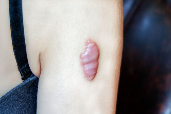 Penyebab Keloid serta Pencegahan dan Perawatannya