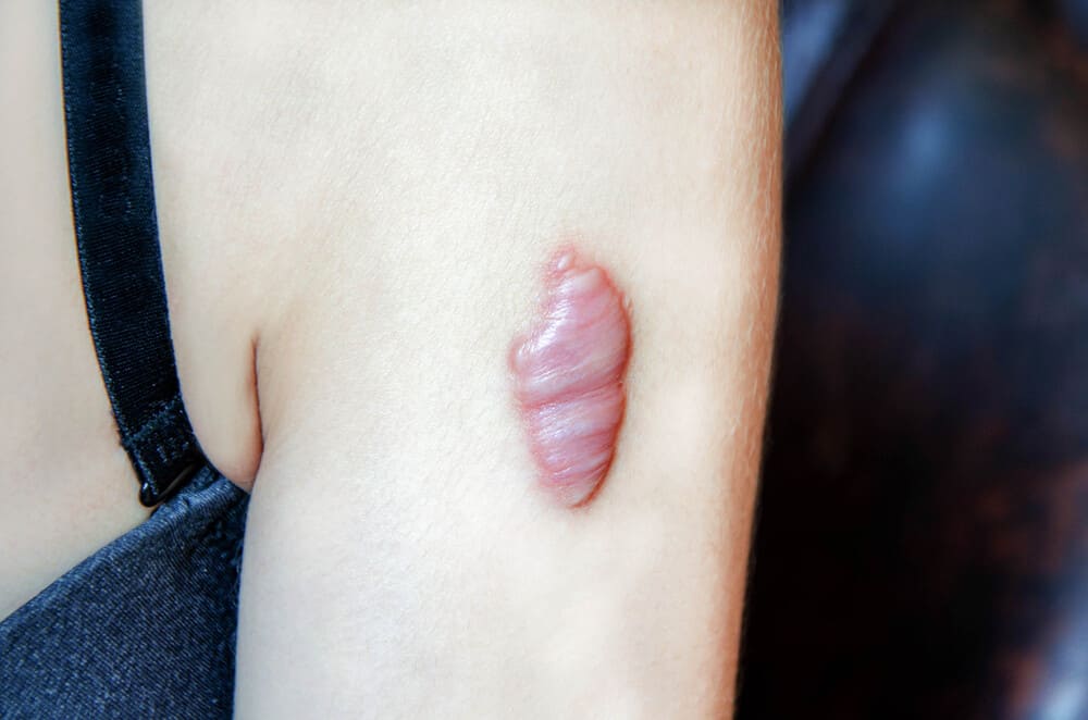 Read more about the article Penyebab Keloid serta Pencegahan dan Perawatannya