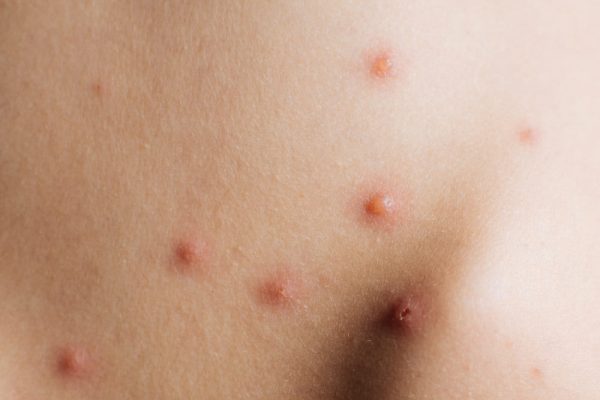 Tips Perawatan Cacar Air pada Bayi