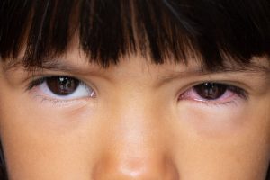 11 penyakit penyebab mata merah