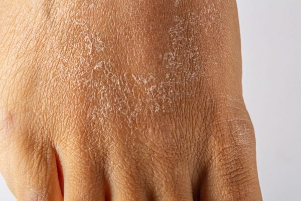 7 Cara Ampuh Mengatasi Kulit Kering