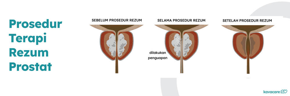 Infografis Prosedur Terapi Rezum Prostat - Kavacare