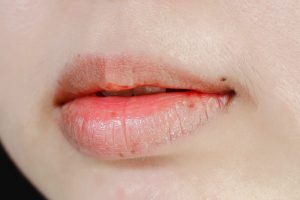 Kenapa Bibir Kering, Penyebab Bibir Kering, Cara Mengatasi Bibir Kering