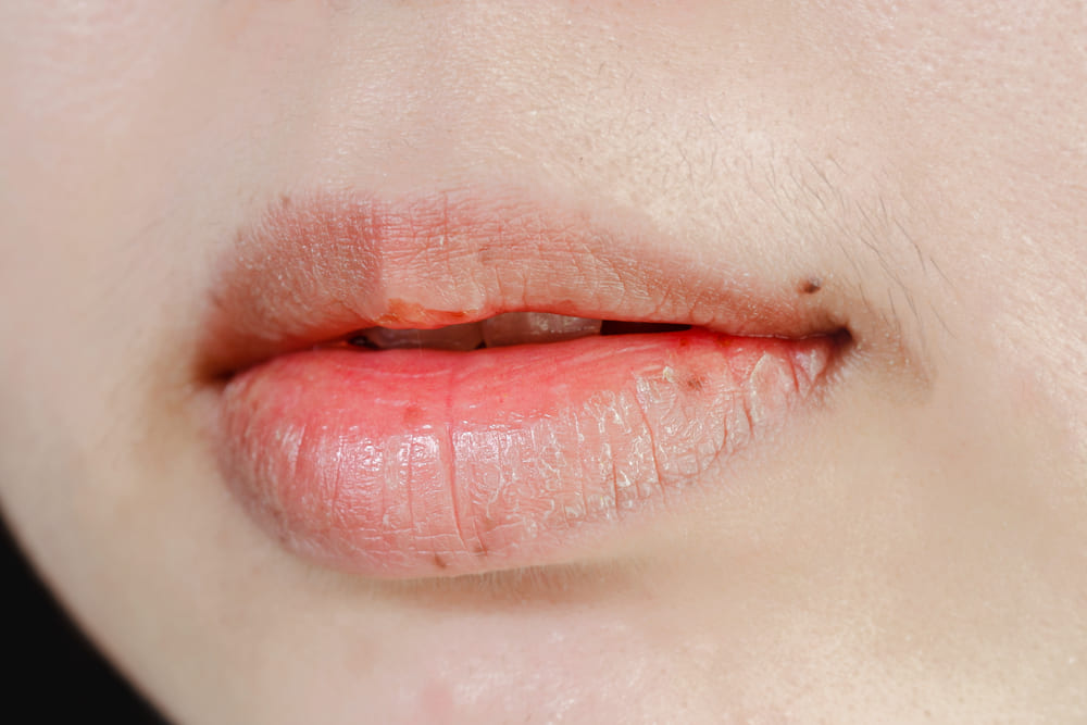 Read more about the article Kenapa Bibir Kering? Penyebab dan 8 Cara Mengatasi