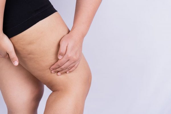 Prosedur Thigh Lift: Risiko dan Rekomendasi Rumah Sakit [2025]