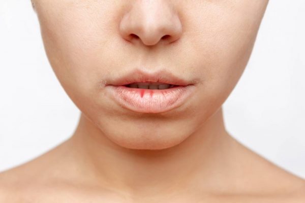 Bibir Pecah-Pecah? Mungkin Ini 6 Penyebabnya!