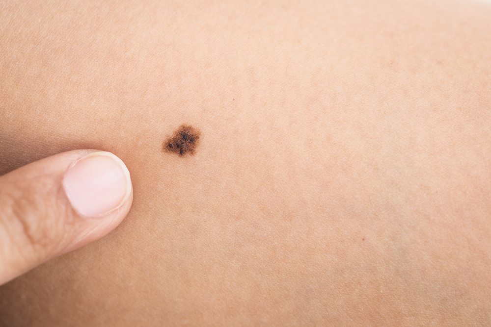 Tahi Lalat Berbahaya atau Normal? Kenali dengan ABCDE! 7 tahi lalat berbahaya