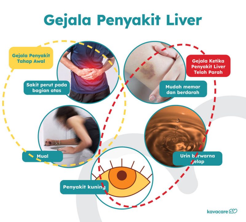 infografis gejala penyakit liver