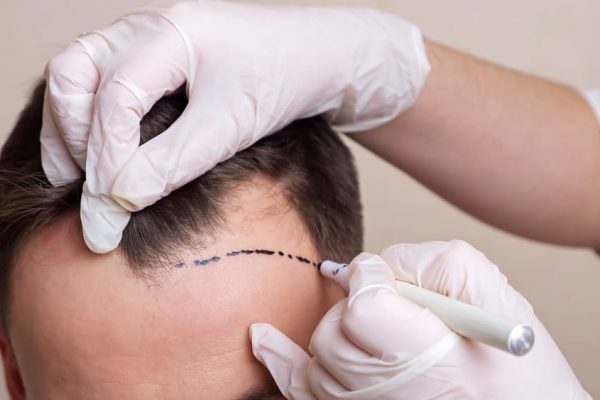 Transplantasi Rambut: Prosedur dan Estimasi Biaya [2026]