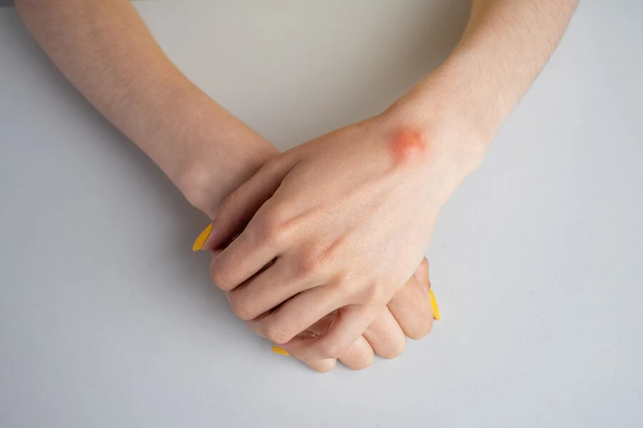 Read more about the article Kenali Jenis-Jenis dan Cara Pencegahan Kista Ganglion