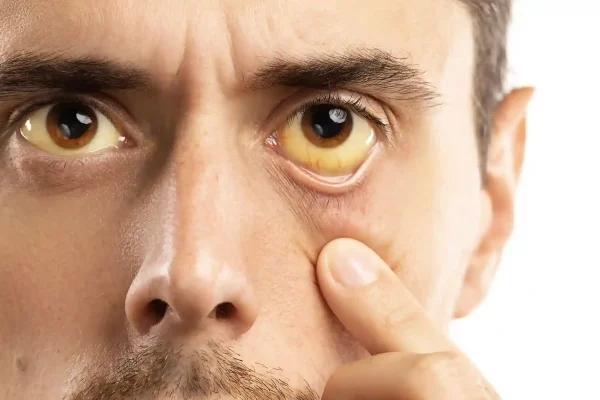 Waspada! 7 Penyebab Mata Kuning pada Remaja yang Sering Diabaikan
