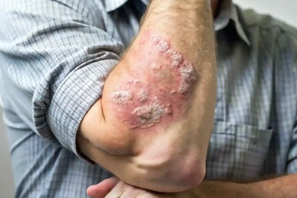 Apa Saja Gejala Psoriasis yang Perlu Diwaspadai?